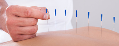 acupuncture, Chinese medicine, tcm, upper beach, beaches acupuncture